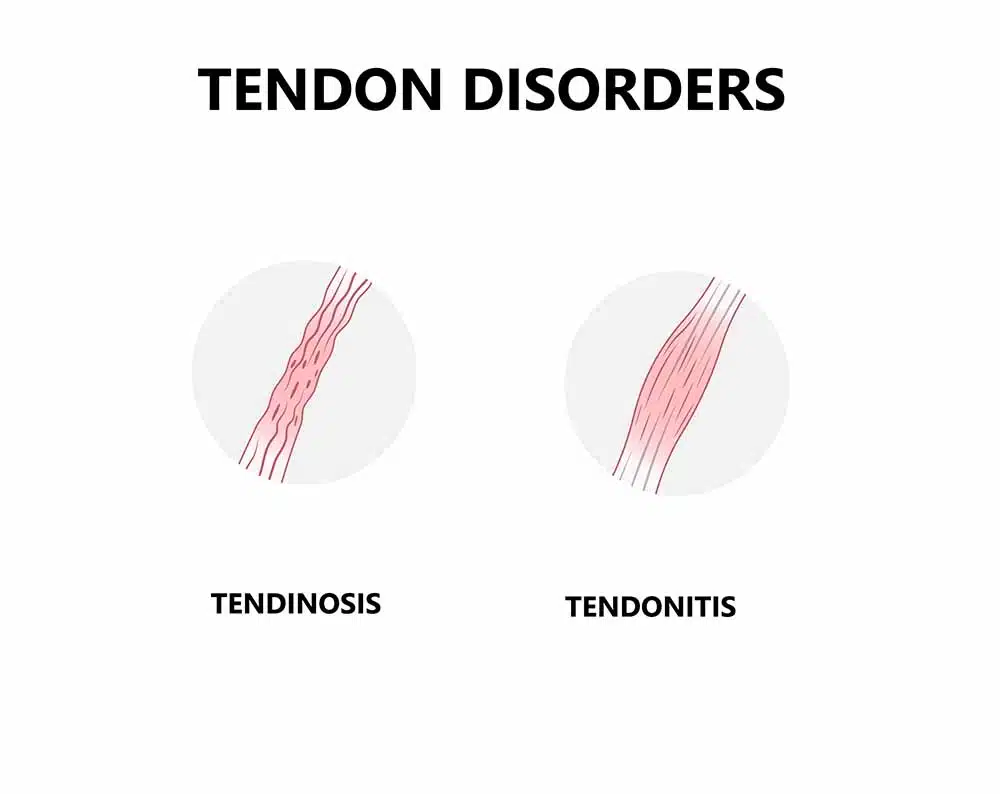 tendonitis vs tendinosis