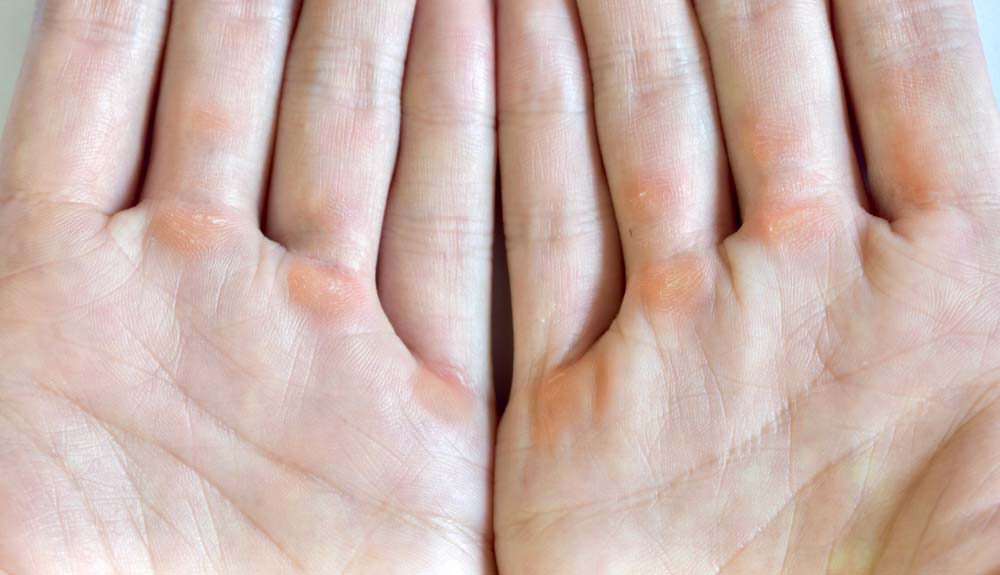 climbers hands with calluses