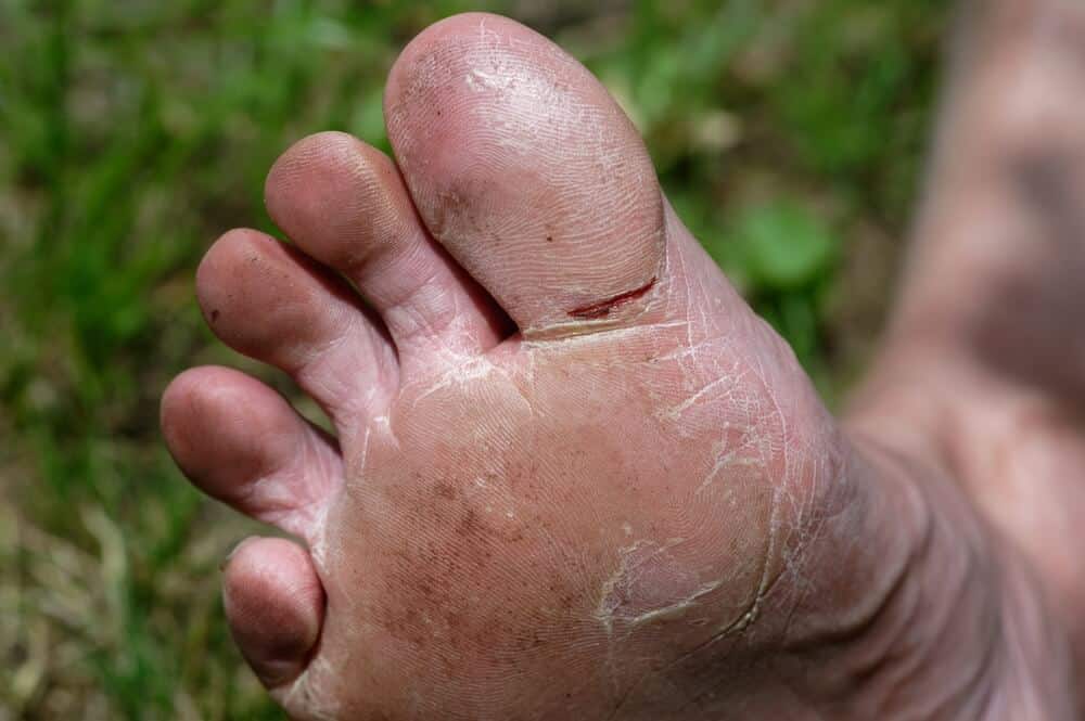 cut toe skin from climbing